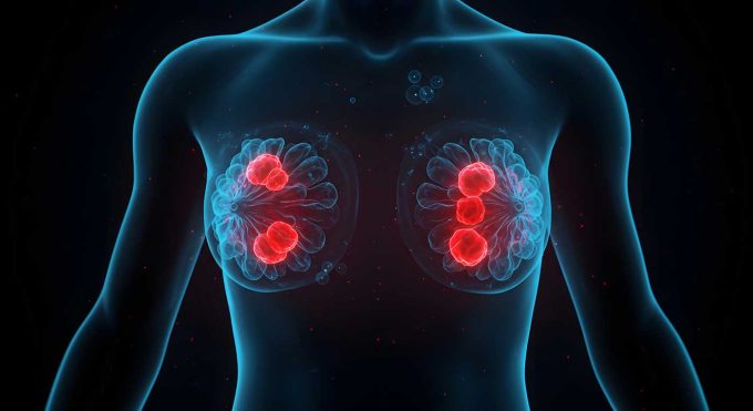 Breast Cancer Prevention Part 3: Advanced Integrative Strategies and Environmental Detoxification