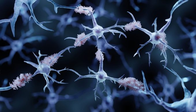 Alzheimers Disease Alzheimer's Disease