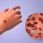 The Hidden Epidemic: Understanding Chronic Lyme Disease and Why So Many Are Still Suffering