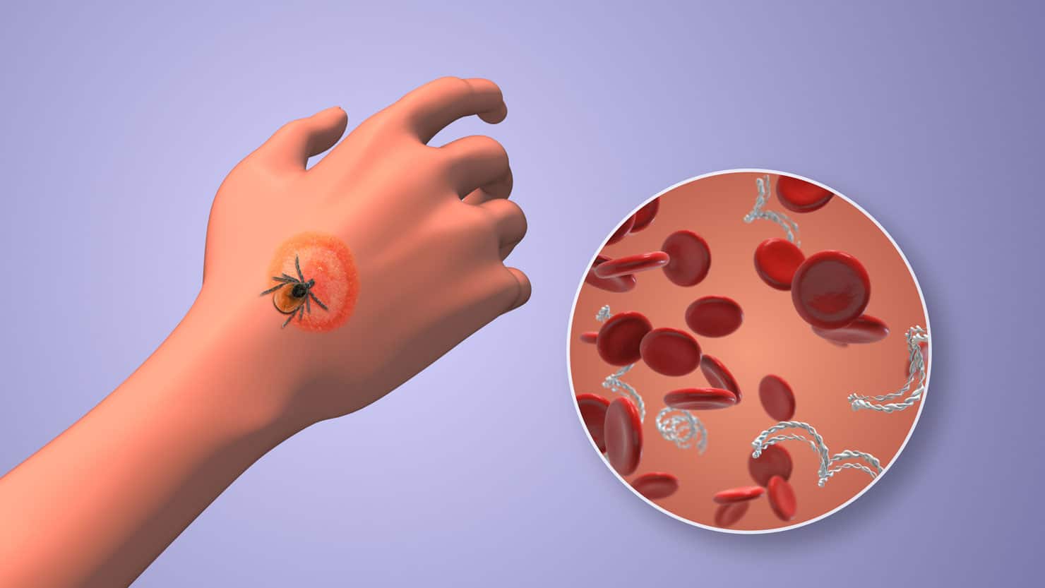 The Hidden Epidemic: Understanding Chronic Lyme Disease and Why So Many Are Still Suffering